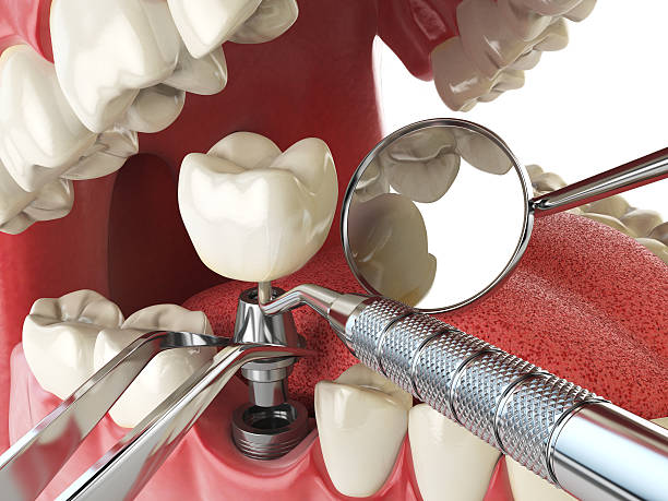 Best Chipped Tooth Repair Near Me  in Manorville, NY